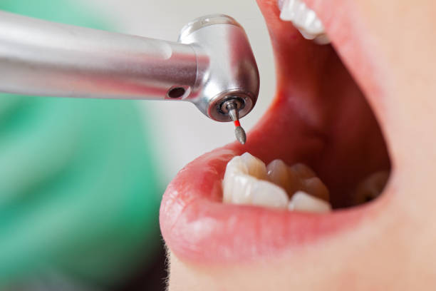 Best Emergency Root Canal Treatment in Shasta, CA